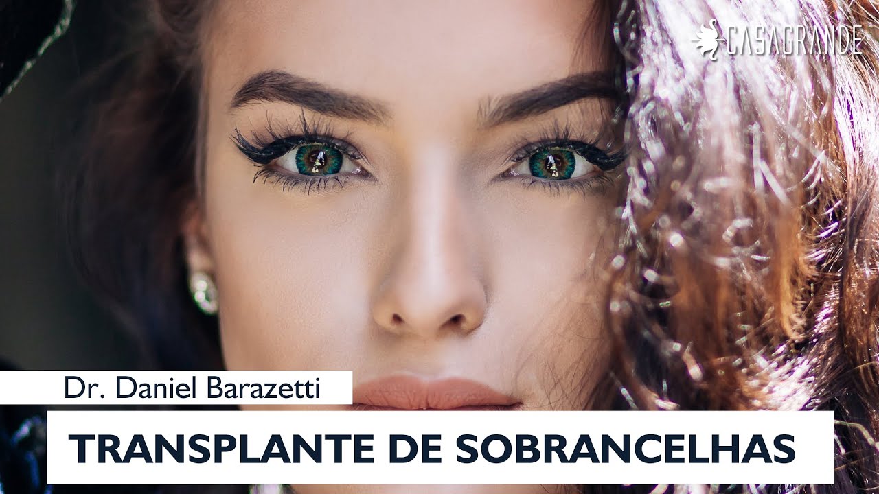 TRANSPLANTE DE SOBRANCELHAS COM RESULTADO NATURAL