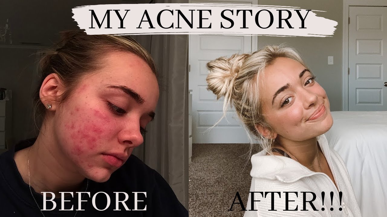 MY BIGGEST INSECURITY | my acne story