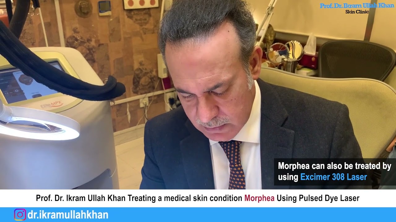 Morphea No More! Pulsed Dye Laser Therapy Unveiled for Treatment! #morpheatreatment #lasermachine