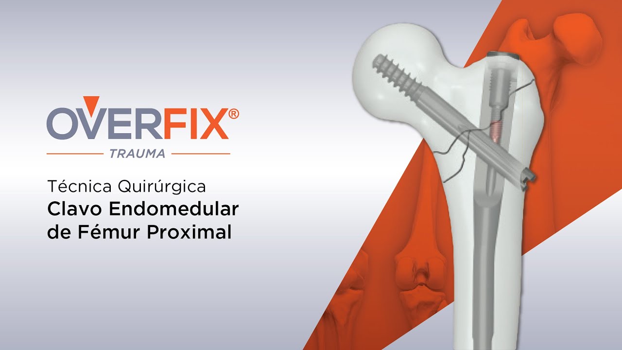 Técnica Quirúrgica Clavo Endomedular de Fémur Proximal RAMIC