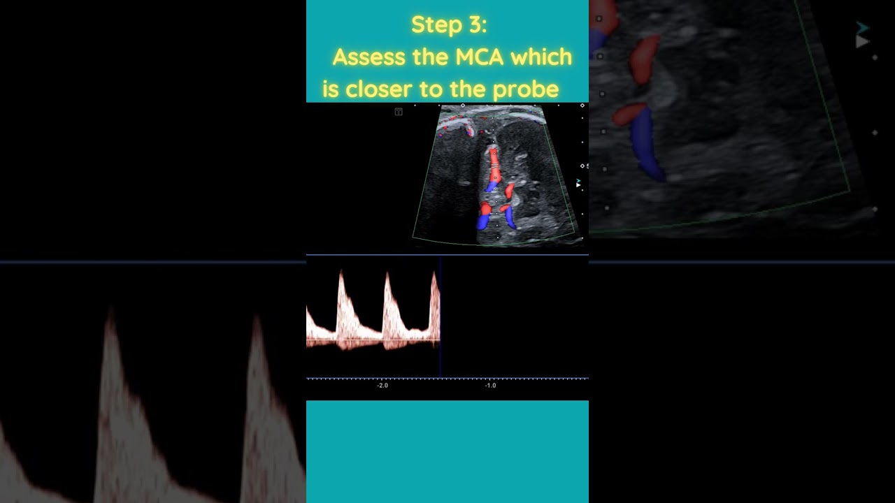 HOW to perform Doppler Ultrasound of Middle Cerebral Artery (MCA).