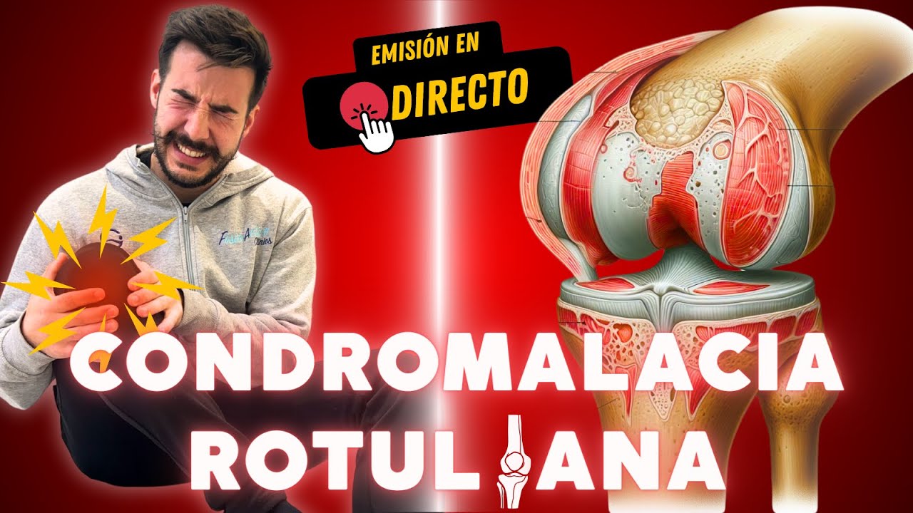 🔴 CONDROMALACIA ROTULIANA: Los Ejercicios que Debes HACER y Todo lo que Necesitas SABER