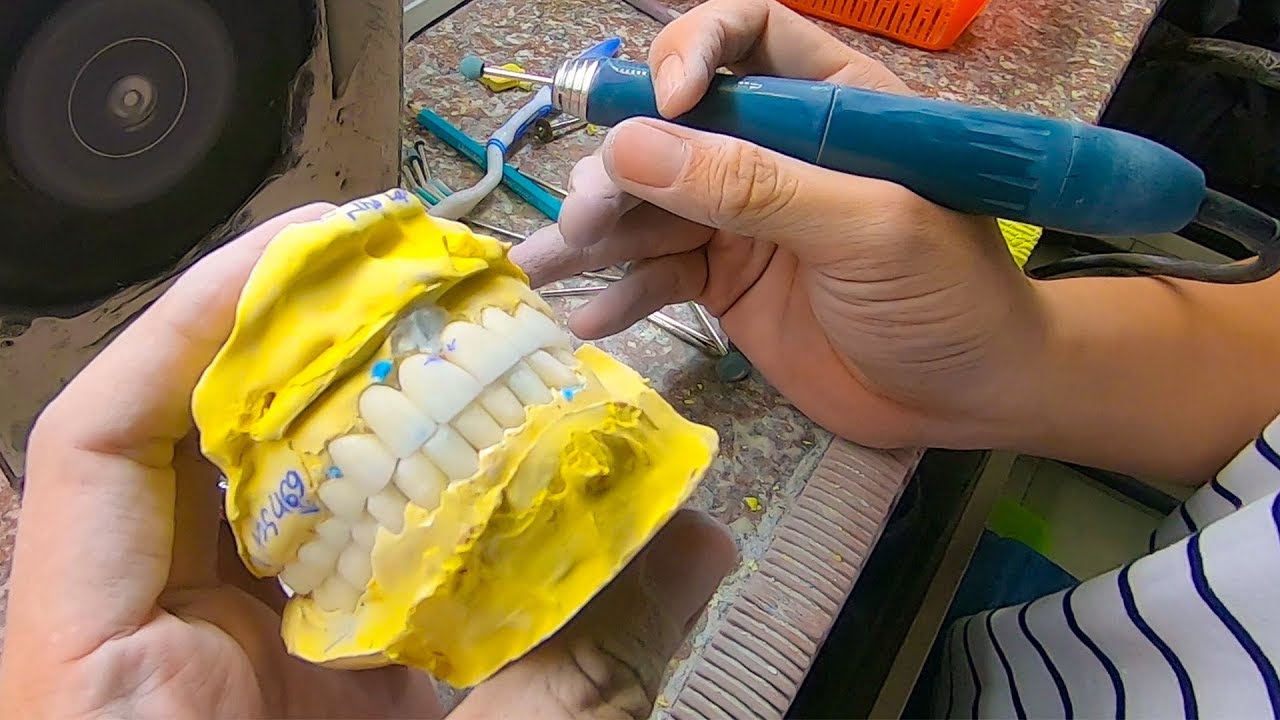 Hé lộ cách làm răng Sứ thẩm mỹ, răng toàn sứ, răng sứ kim loại hiện đại nhất Việt Nam