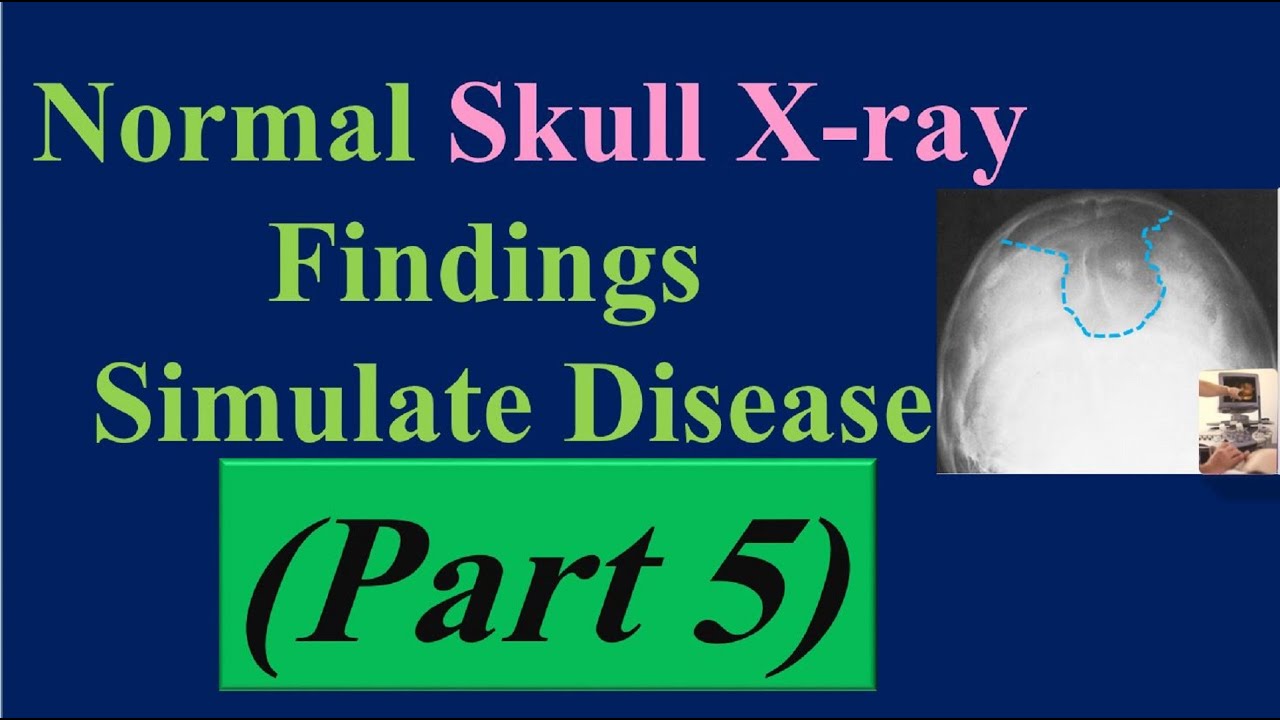 Normal Skull X-ray Findings Simulate Disease (part 5)-Calvarial Doughnut Lesions