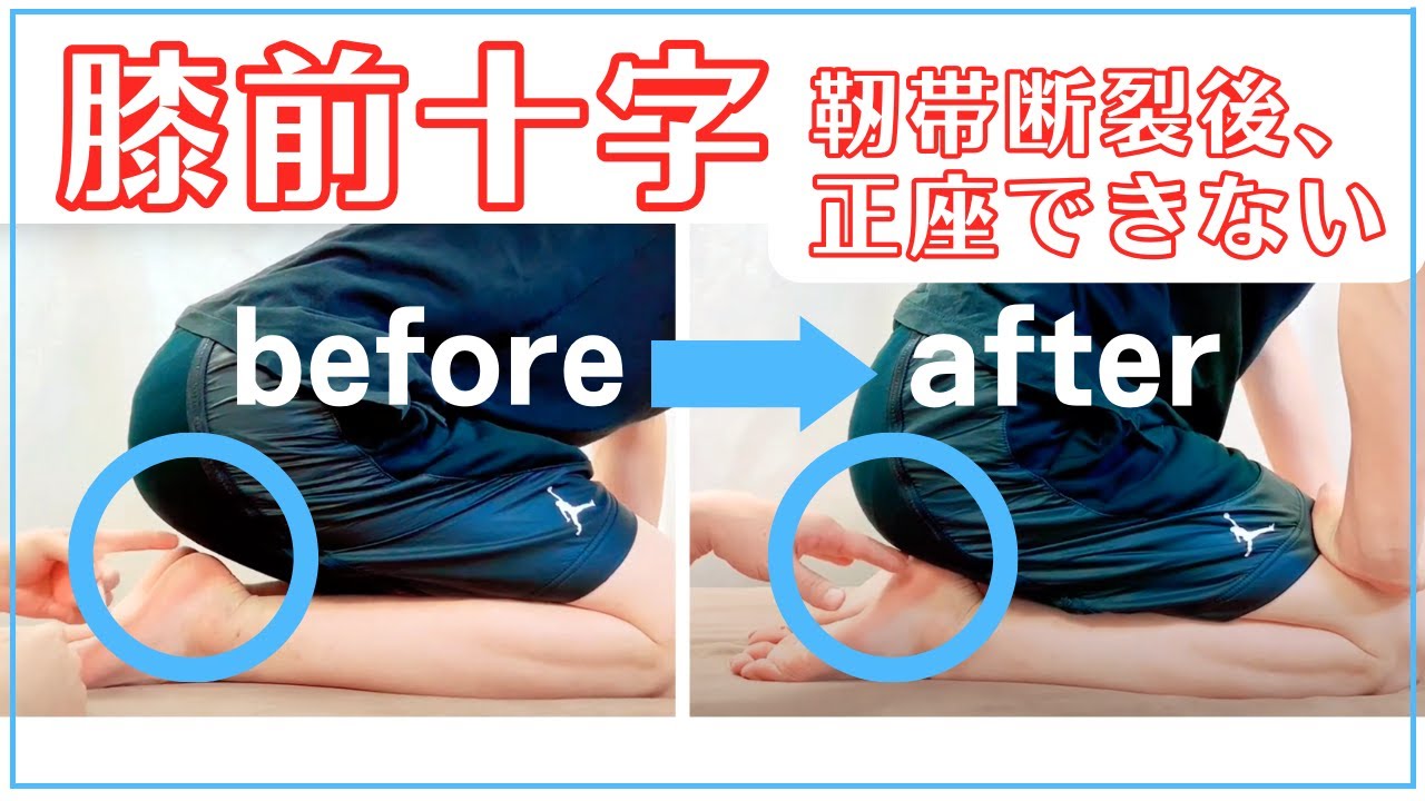 【実録】サッカーで前十字靭帯（ACL）断裂！手術後から膝が最後まで曲がらず、しゃがめない患者さん。筋肉、関節、皮ふの癒着に対する手技で完治を目指す方法。