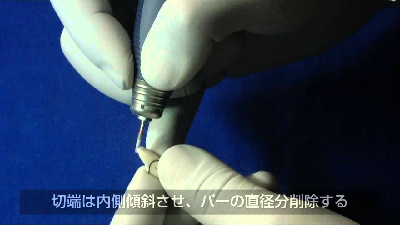 西川義昌先生・支台歯形成前歯編