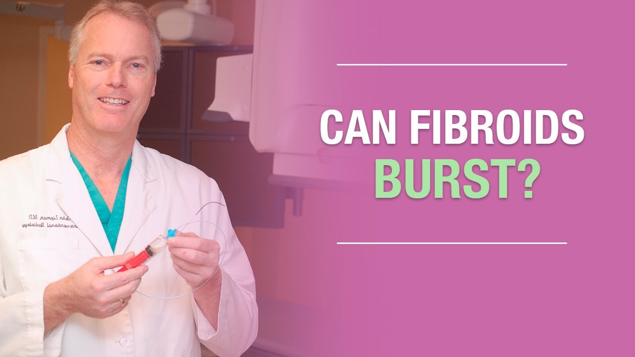 Ask Dr. John Lipman: Can Fibroids Burst?