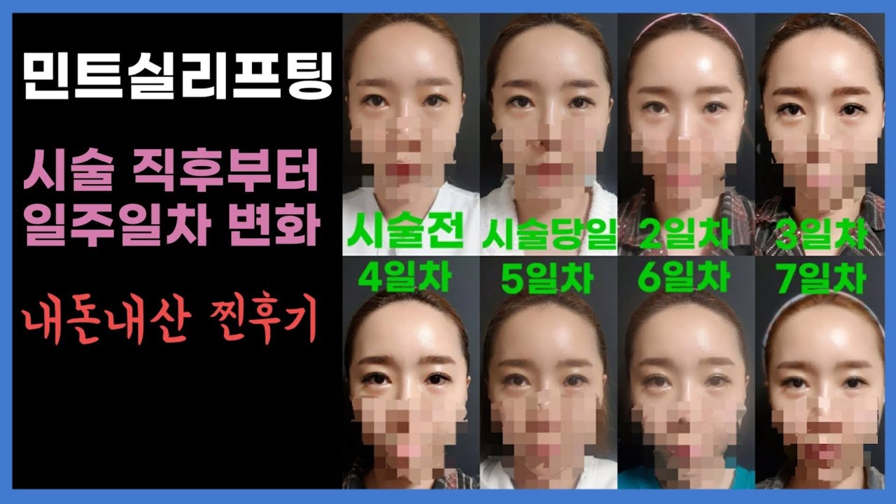 민트실리프팅 일주일차 후기/일주일간의 얼굴변화