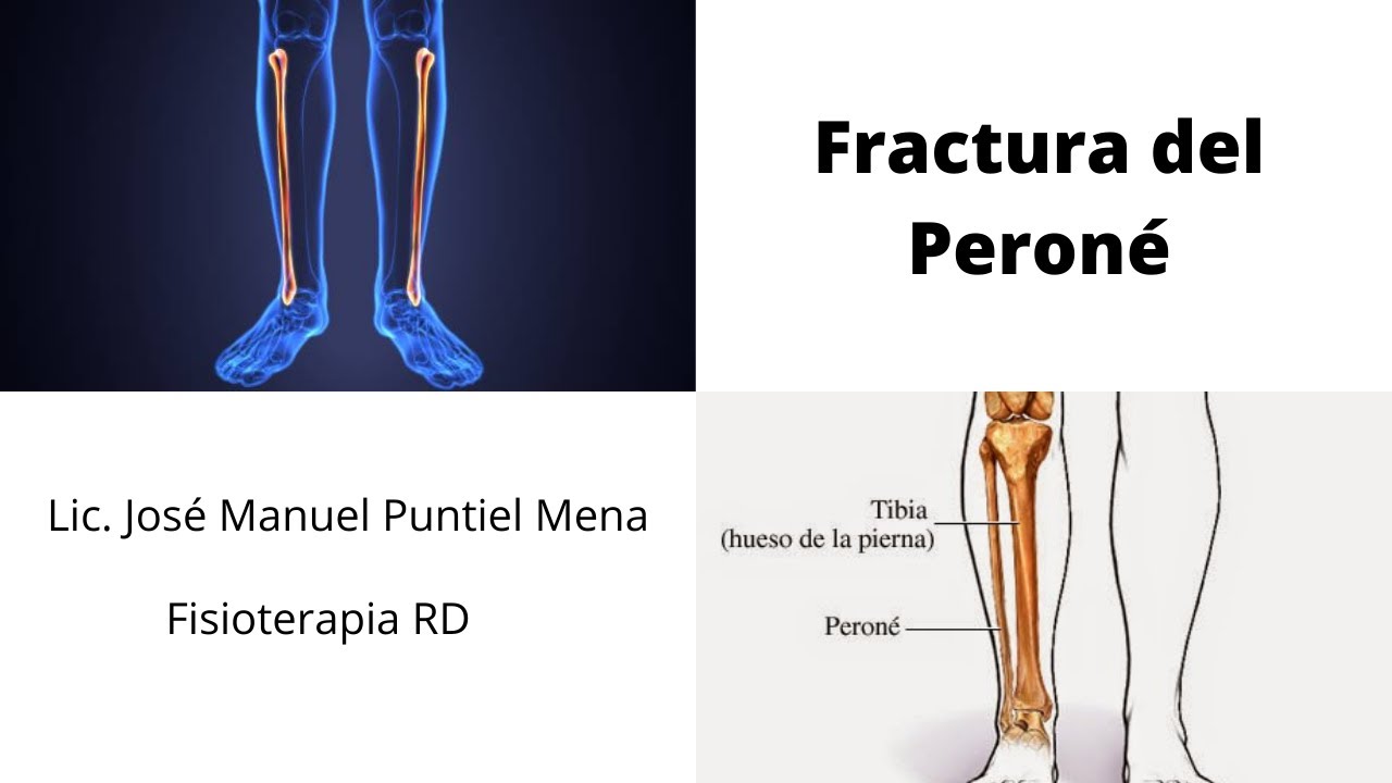 Rehabilitación luego de una Fractura del Peroné - FisioterapiaRD