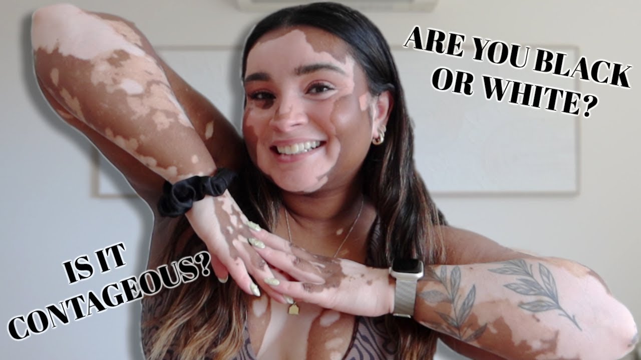 VITILIGO Q&A