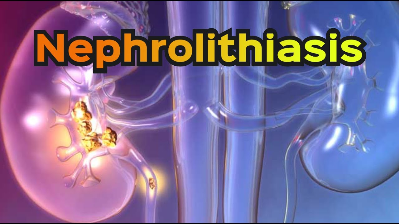 Nephrolithiasis (Kidney Stones) - CRASH! Medical Review Series