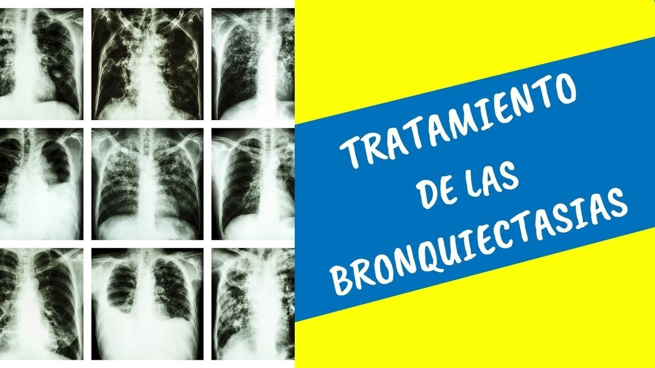 Bronquiectasias ¿Cuál es el tratamiento correcto?