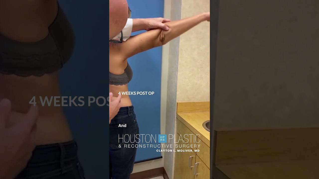 Arm lift scar - totally hidden. #scarhealing #plasticsurgeon