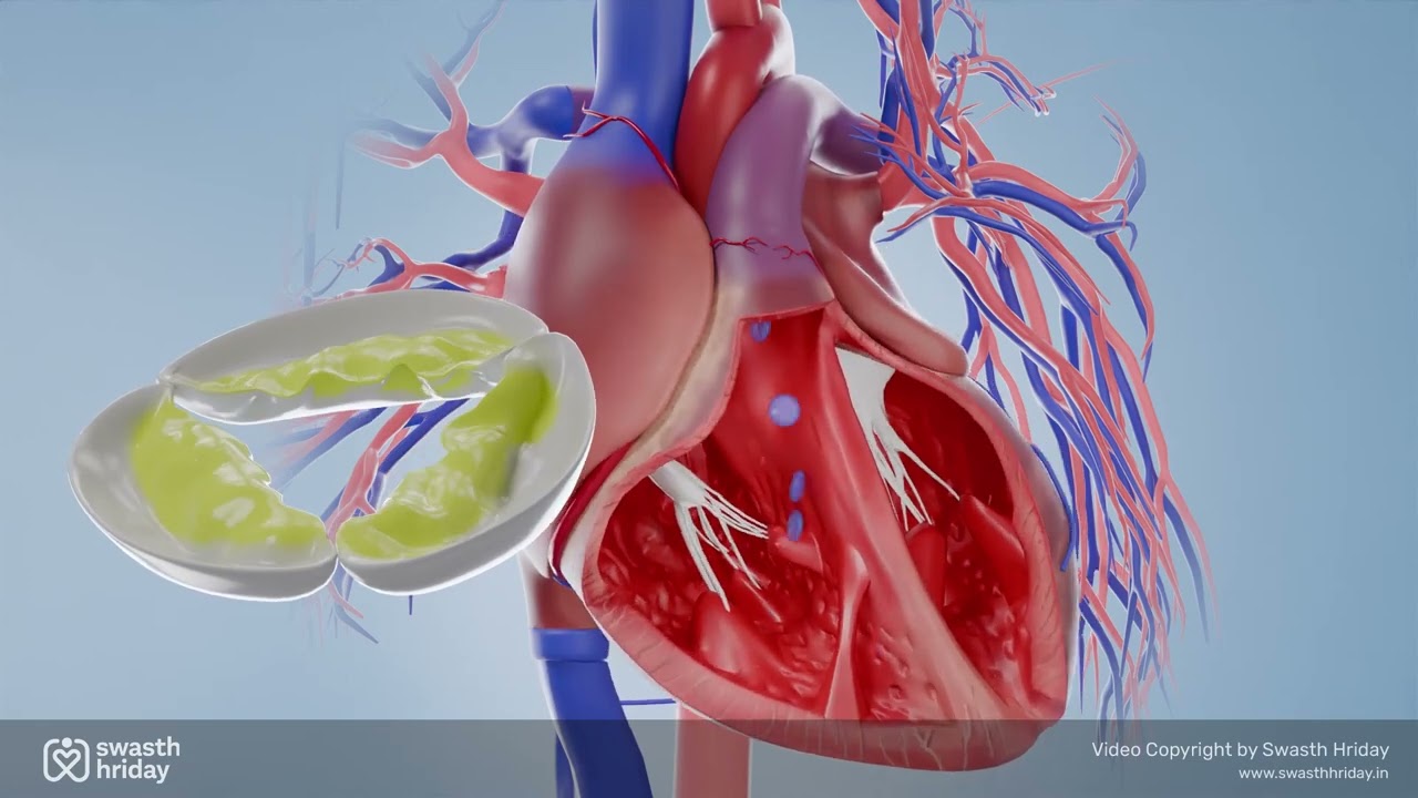 Aortic Valve Replacement | Aortic Valve Replacement Surgery Animation | Swasth Hriday