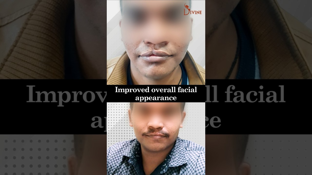 Transforming Lives: The Impact of Unilateral Cleft Lip Surgery | Cleft Lip Before and After