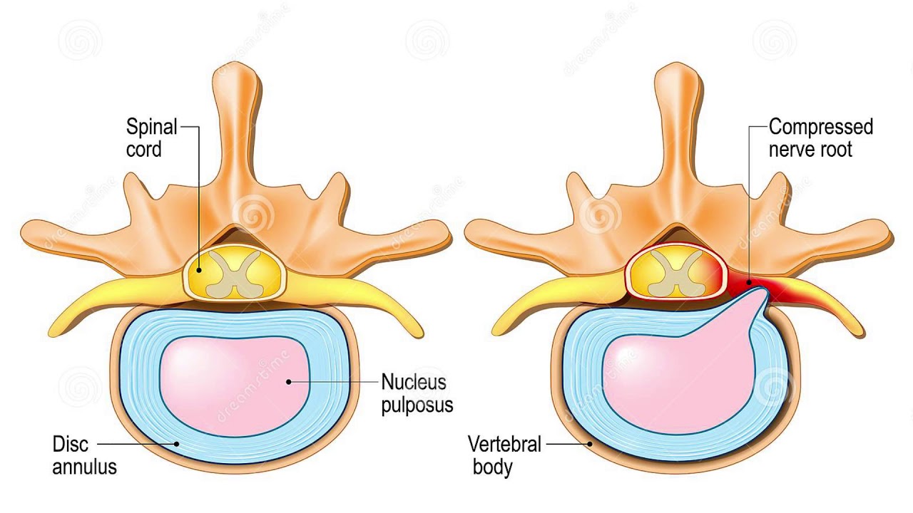 FIT - TEMA: DISKUS HERNIJA