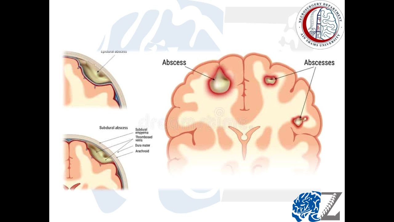 CNS Infection (1) : Brain Abscess (1)  خُراج بالمخ