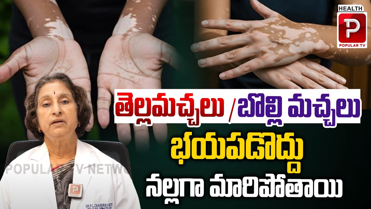 Dr Chandravathi Reveals the BEST Way to Treat White Patches | Health Popular TV