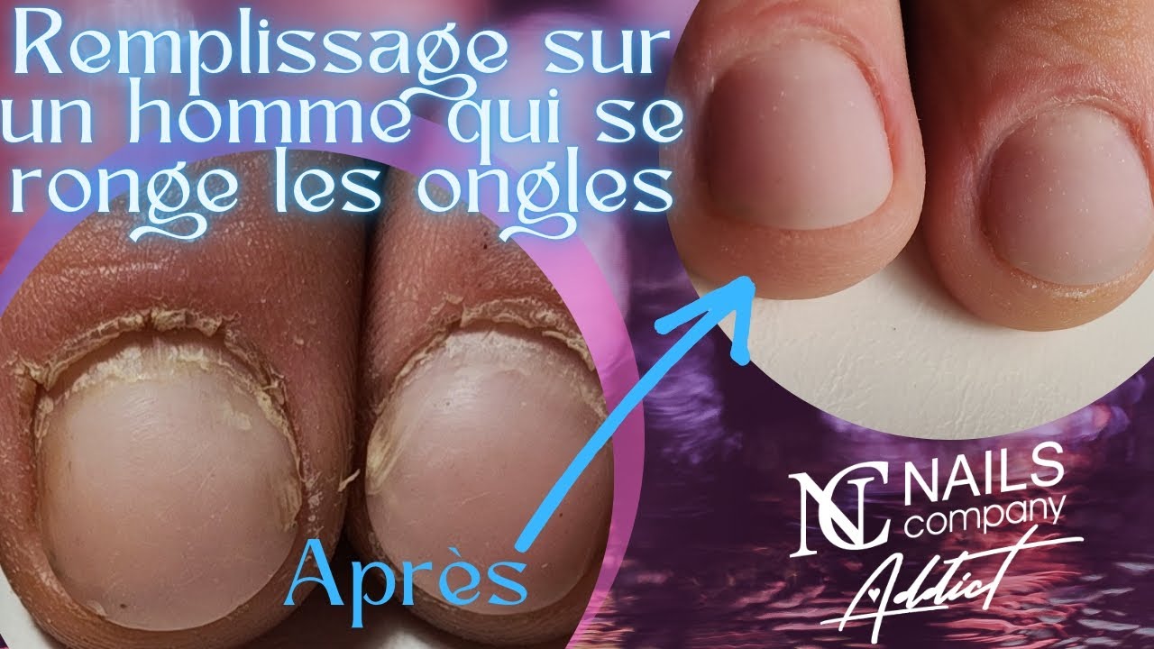 Les HOMMES aussi peuvent porter DU GEL (reconstitution des ongles rongés)