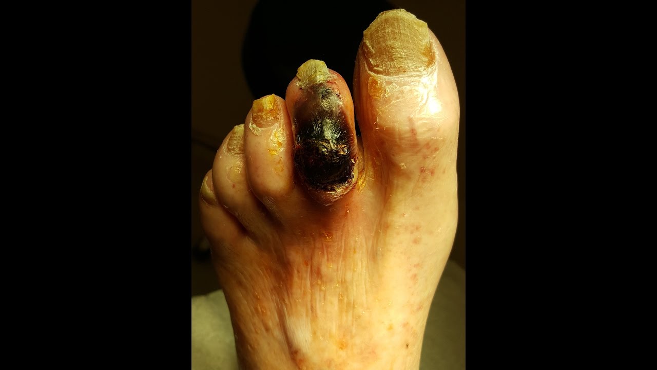 Prevent Gangrene