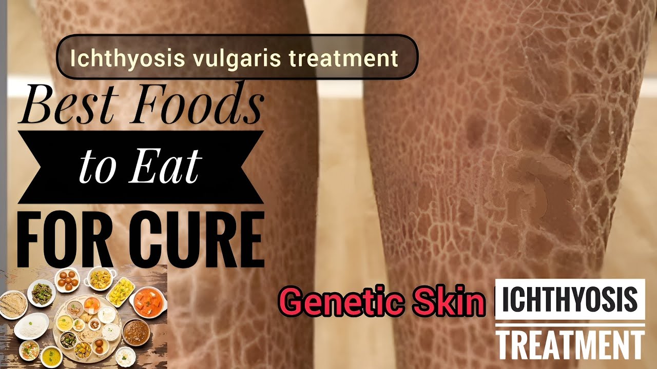 Top 10 Best Foods for Ichthyosis Vulgaris 🥗 | Natural Cure & Healthy Diet 🌿 | Dry Skin Healing Tips