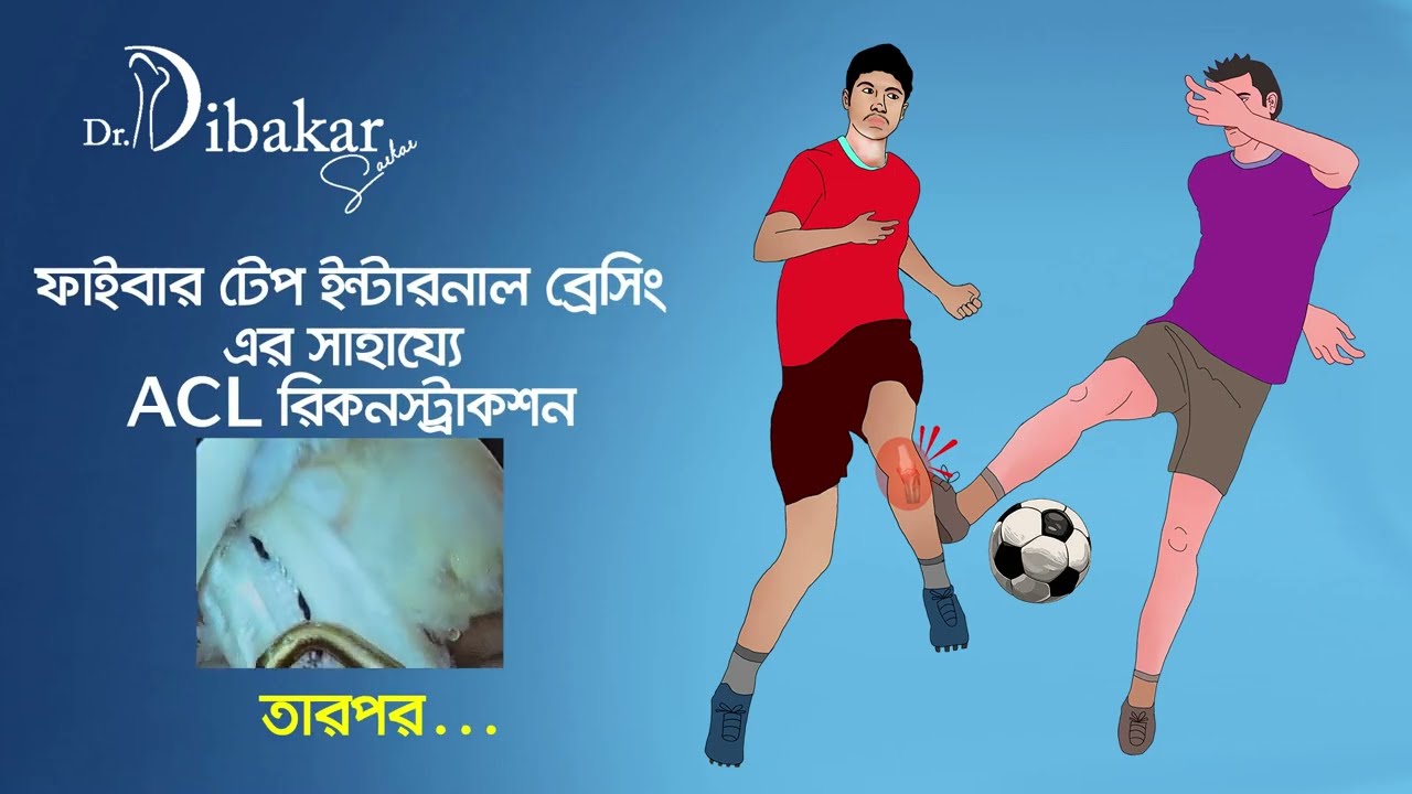 বাংলাদেশেই ফাইবার টেপ ইন্টারনাল ব্রেসিং-এর সাহায্যে ACL রিকনস্ট্রাকশন করে সম্পূর্ণ সুস্থ খালিদ হাসান