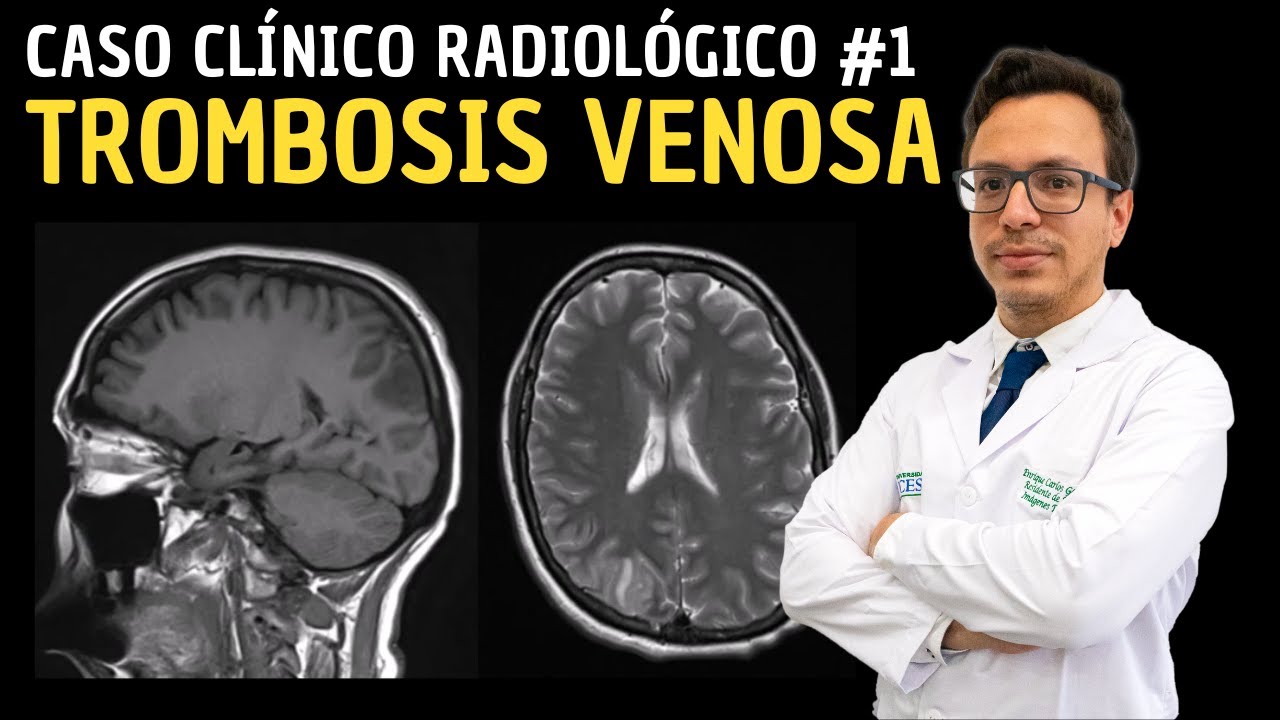 Caso Clínico Radiológico 1: Trombosis Venosa.