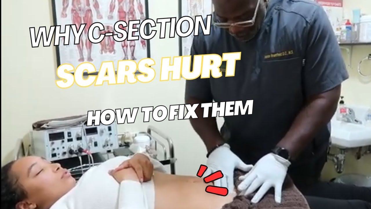 C-Section Scar Complications Nobody Warns You About