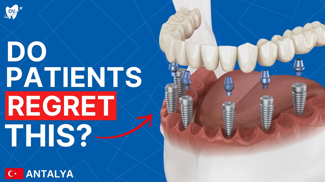 All on 6 Dental Implants in Antalya: UK Patients Review Full Mouth Implants in Turkey