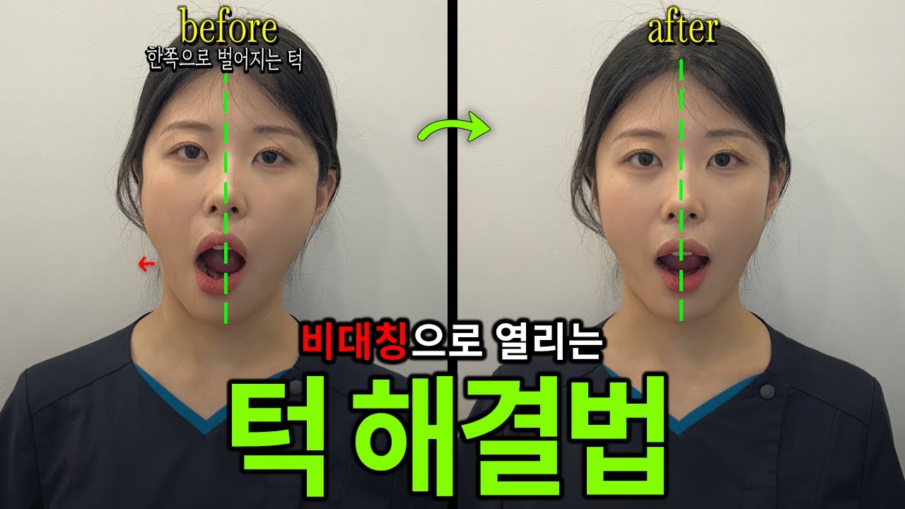안면 비대칭의 주요 원인 : 지그재그로 열리는 