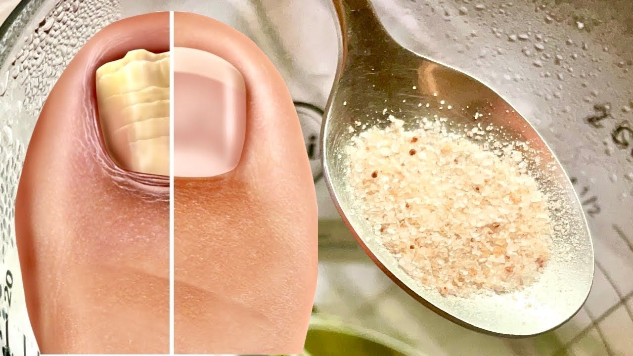 Uklanjanje Gljivica na Noktima: 100% Prirodni Tretman Za Gljivice Na Noktima Nogu