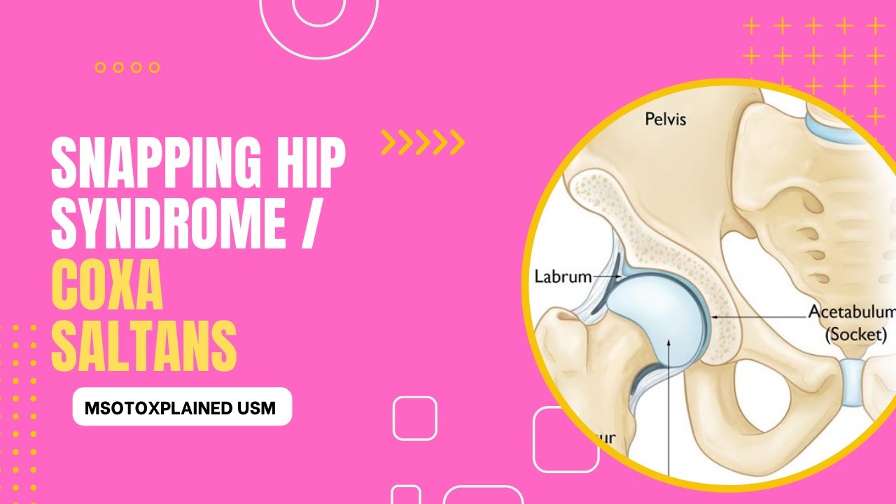 Snapping hip syndrome / Coxa saltans