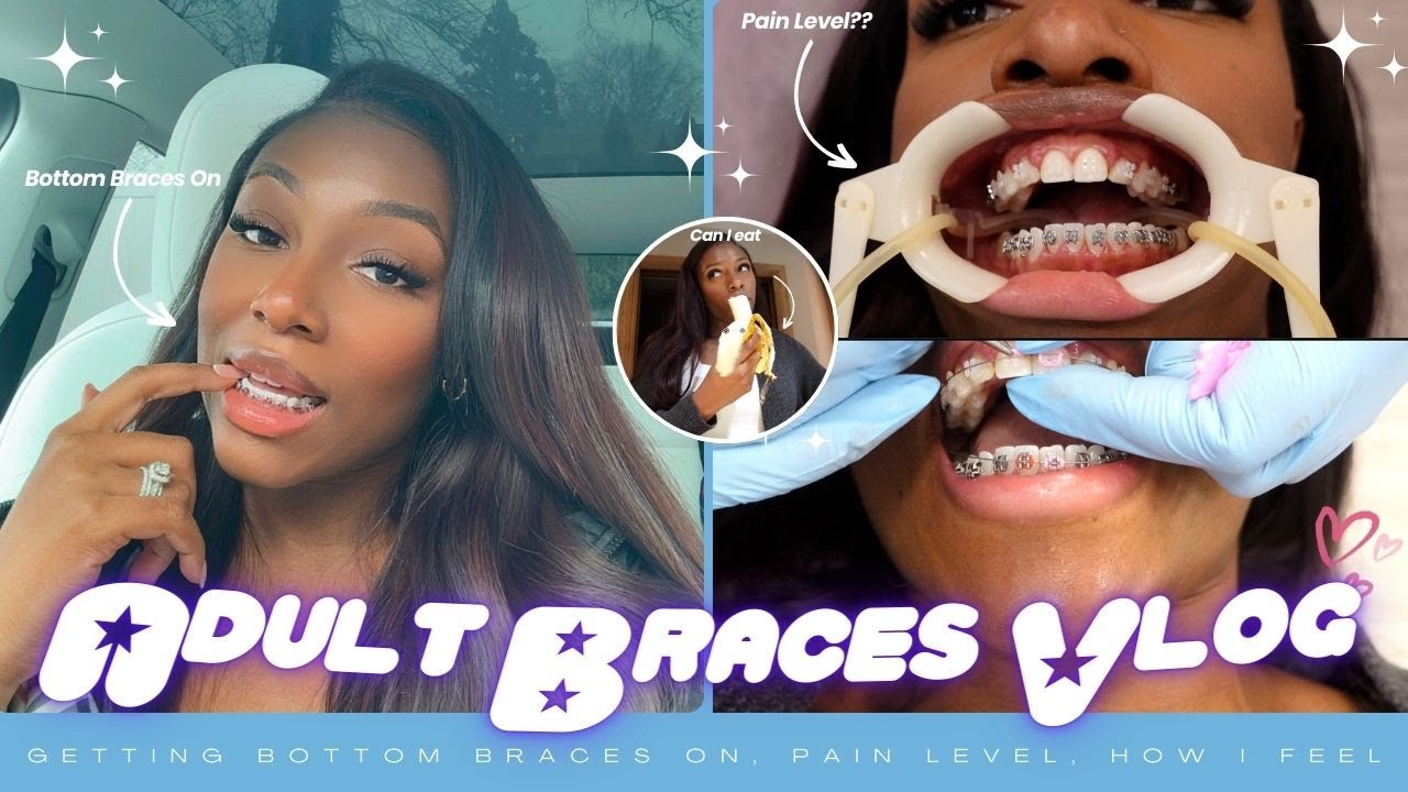 ADULT BRACES Vlog: Ep. 3 ✨ My BOTTOM BRACES are FINALLY on 😁! Pain level, Eating & Can I talk? 🦷