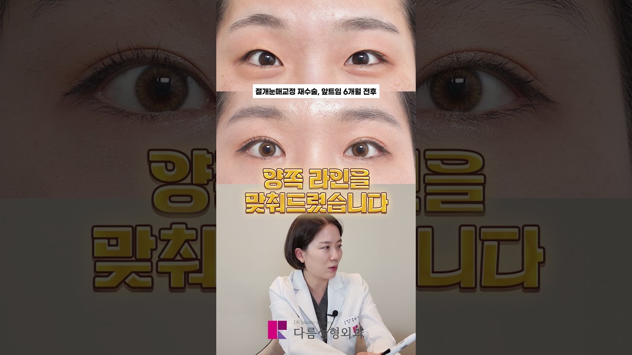 눈두덩이가 얇은데, 지방제거를 추천하는 원장님??  