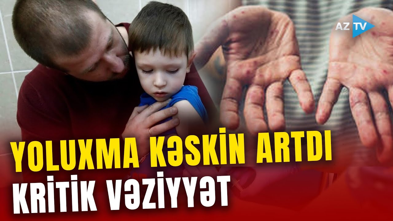 Qızılca SÜRƏTLƏ yayılır - Qonşu ölkədə SON VƏZİYYƏT necədir?