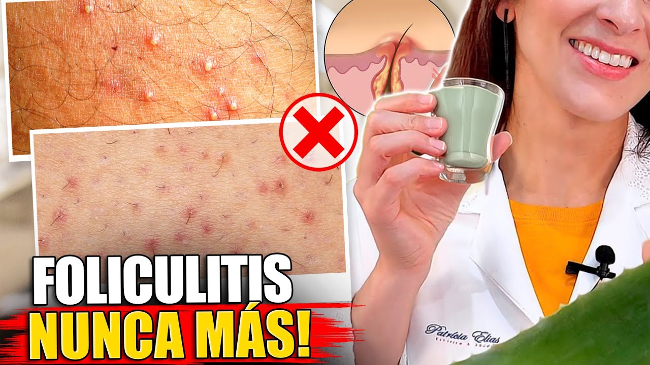 &iexcl;Elimina la FOLICULITIS en las Axilas, la Ingle, la Barba y M&aacute;s!