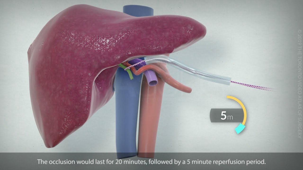 Segment 7/partial segment 8 liver resection for HCC