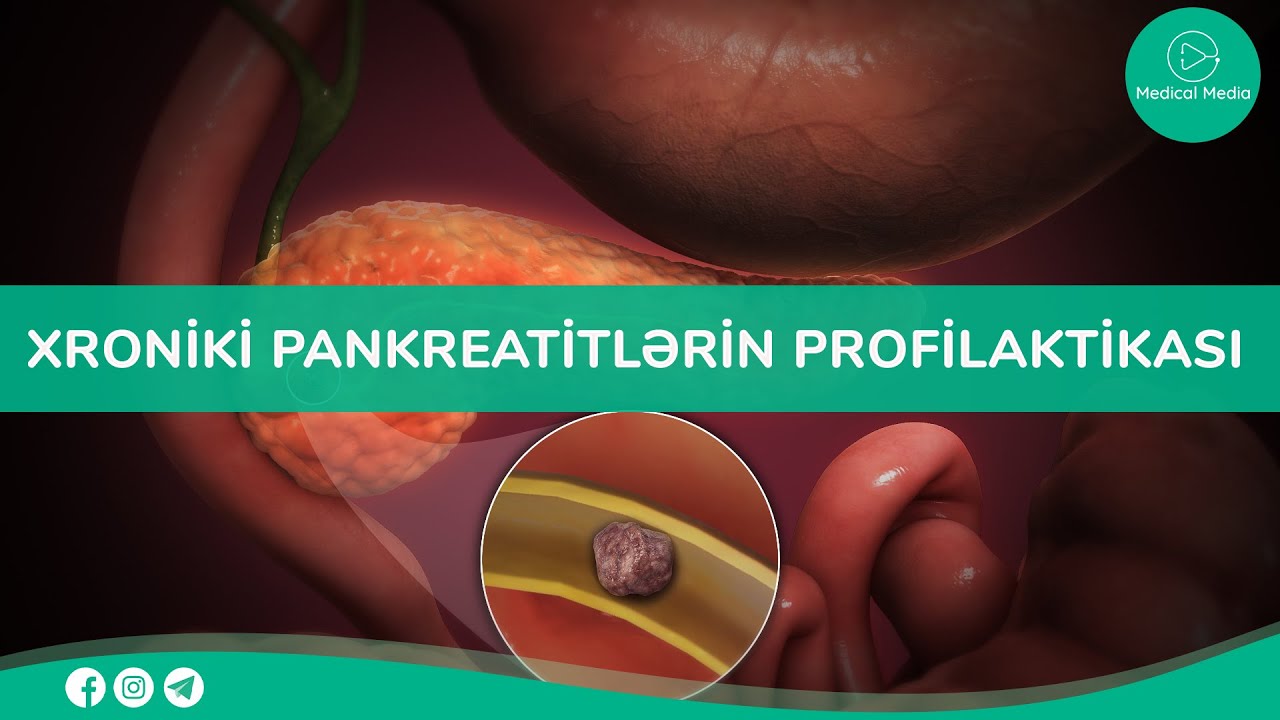 Həkimin qonağı - Xroniki pankreatitlərin profilaktikası