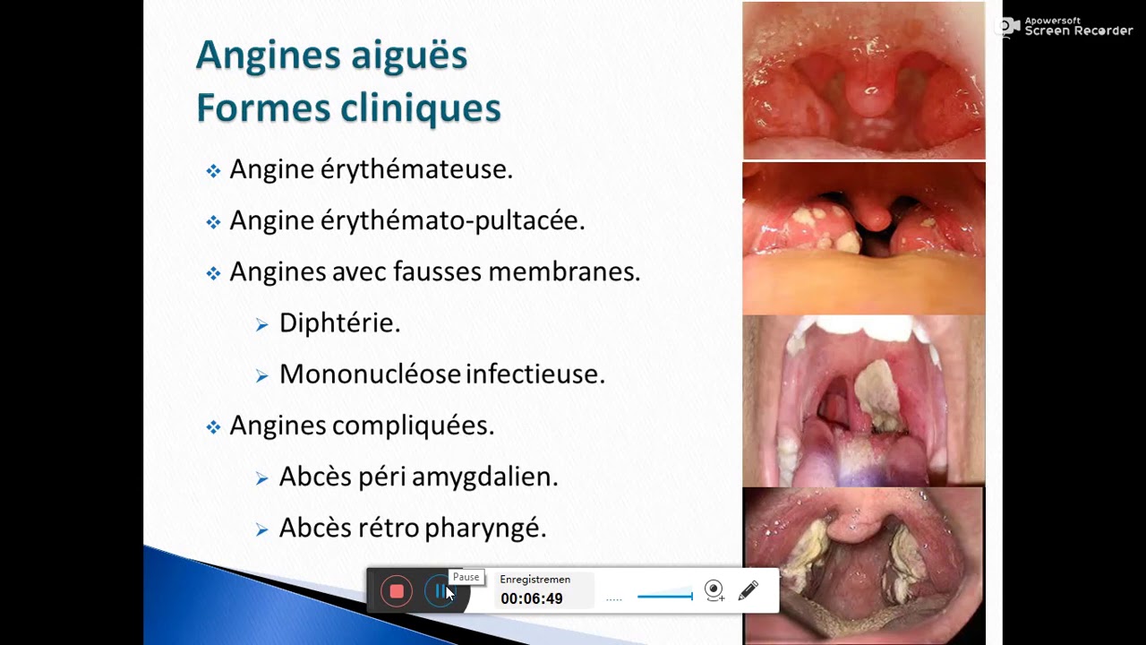 Infections respiratoires aigues Dr M GHARNOUTI