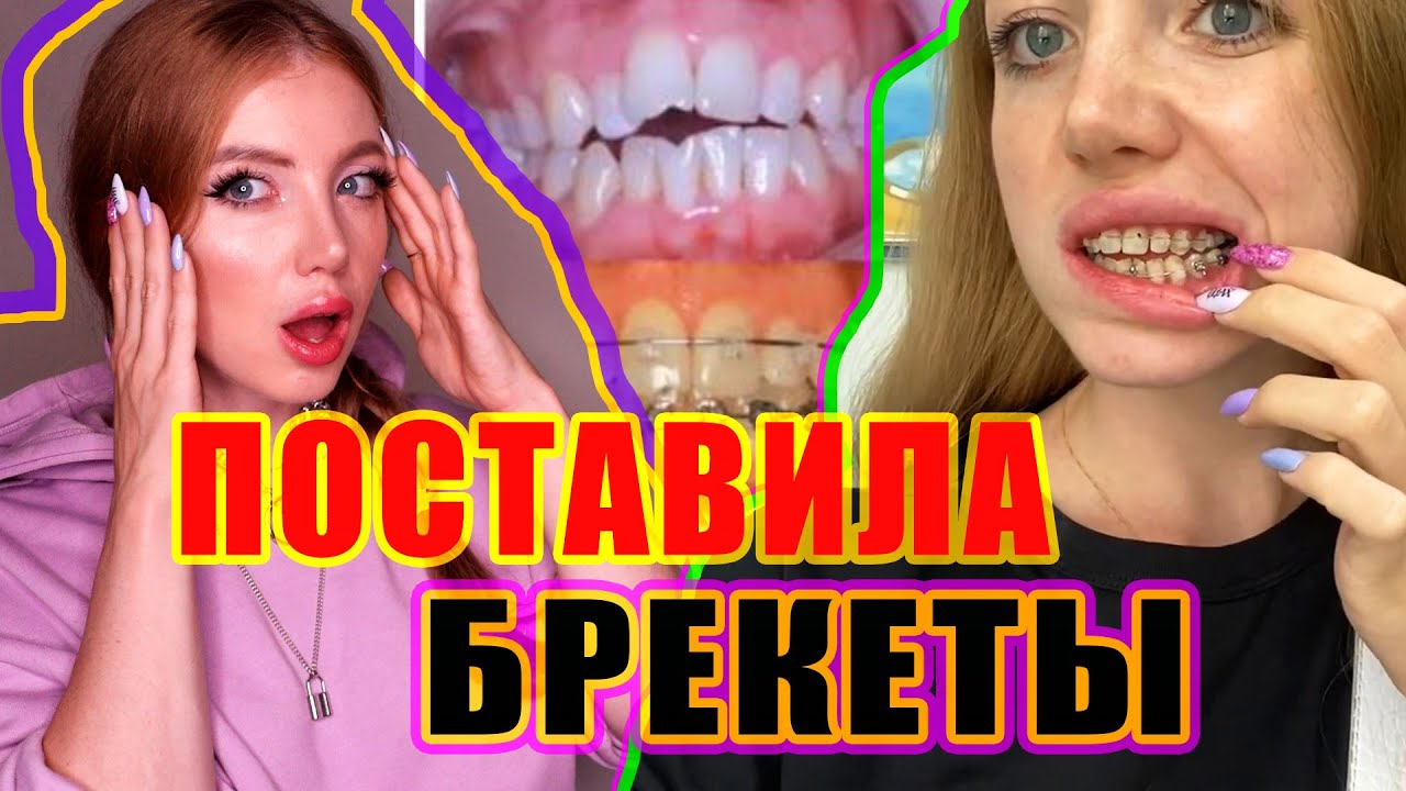 БРЕКЕТЫ - ЦЕНЫ, МОЙ ПРИКУС, УСТАНОВКА И ОПАСНОСТЬ ПОСЛЕ РИНО.