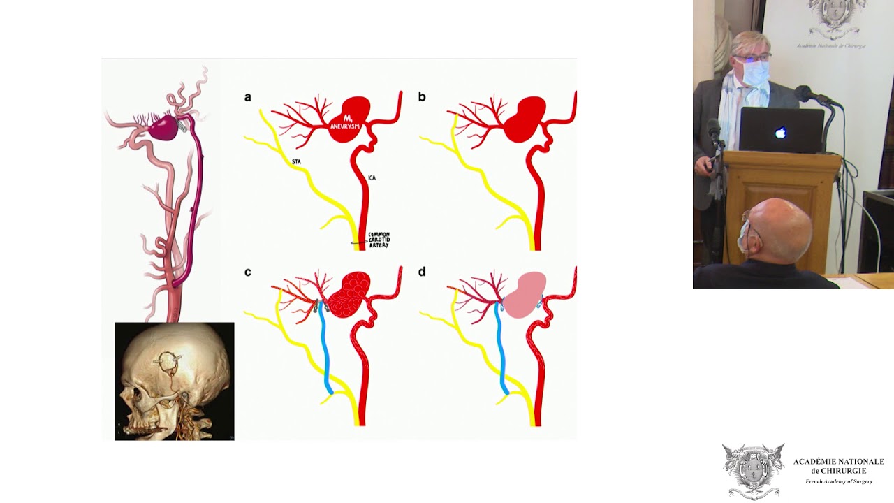 Traitement percutané des anévrismes géants