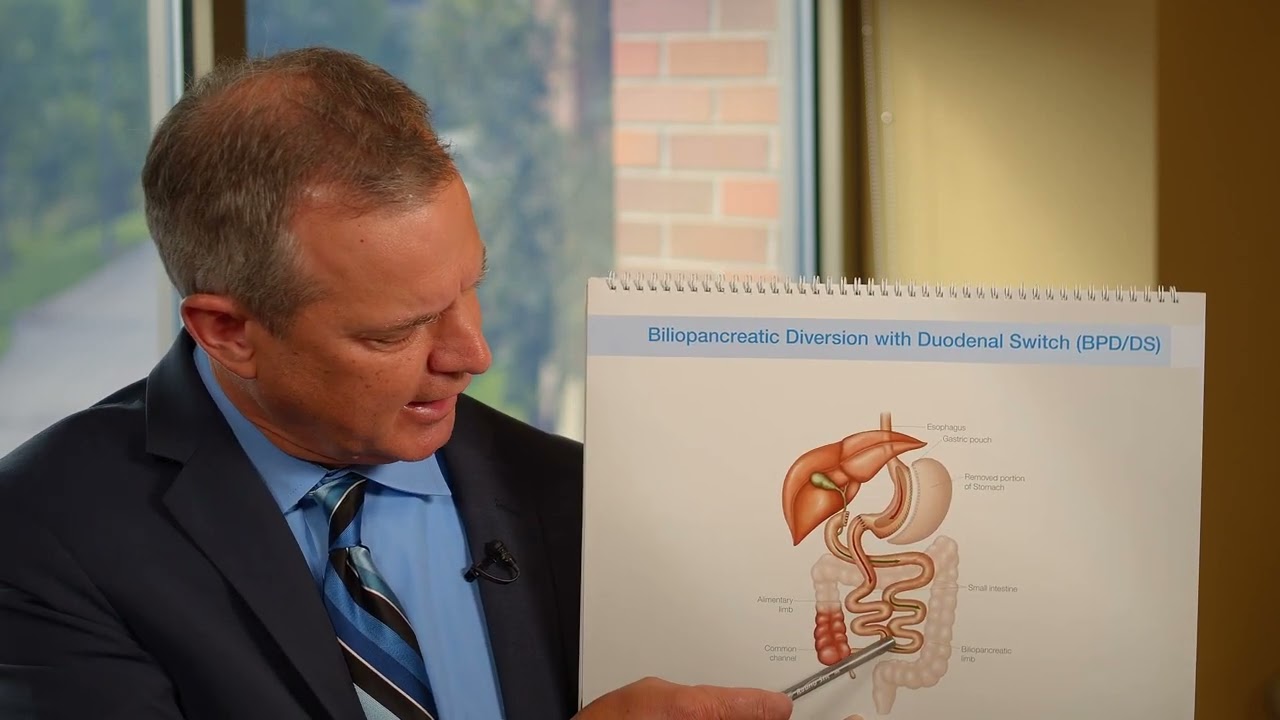 UM Health-West Bariatric Treatment Seminar: Chapter 5: Duodenal Switch & Revision Bariatric Surgery