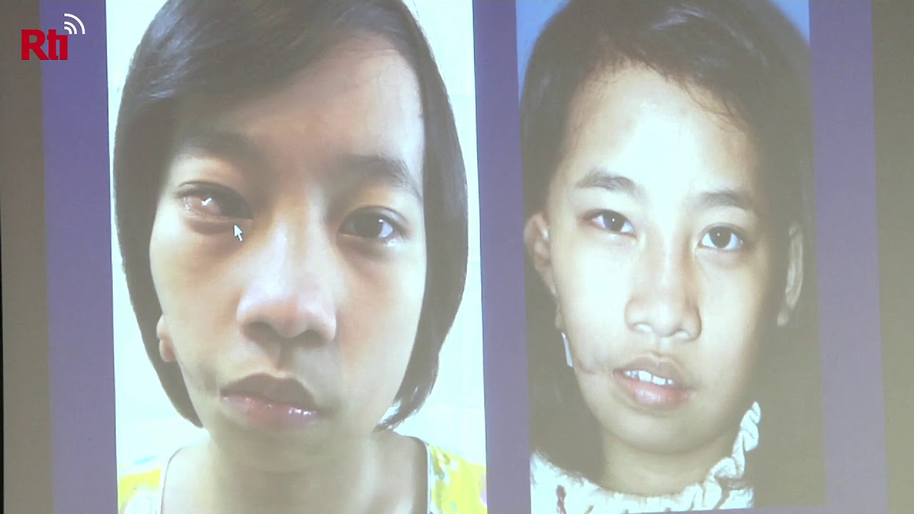 Mengidap Kelainan Goldenhar Syndrome, Gadis Myanmar Menjalankan Pengobatan Taiwan