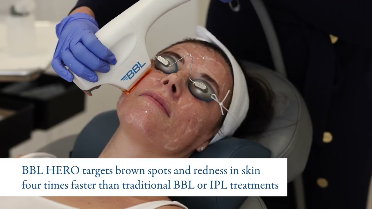 Sciton BBL HERO and MOXI Laser Treatment
