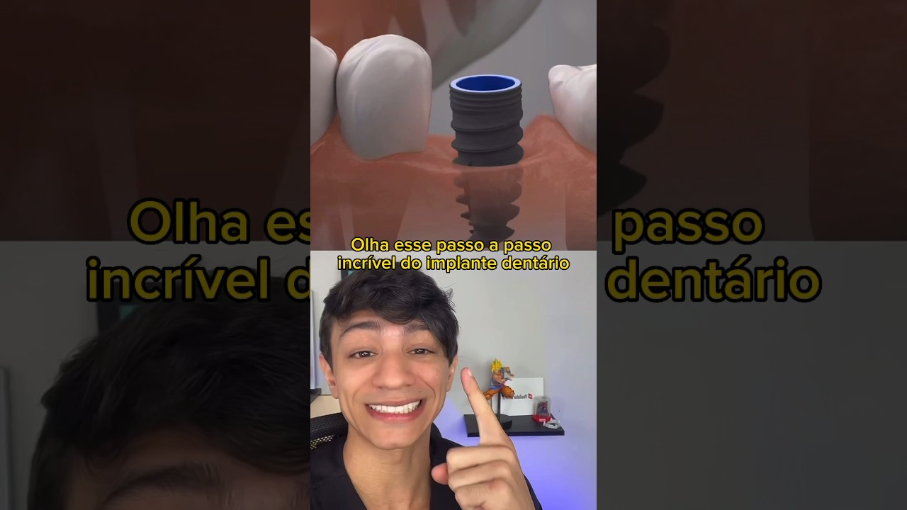 Passo a Passo Implante Dent&aacute;rio em 26 segundos!!! #shorts