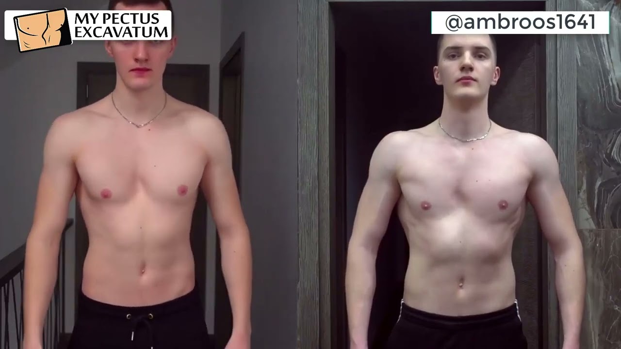 Watch @ambroos1641's Incredible Pectus Excavatum Gym Transformation in Just 150 Days