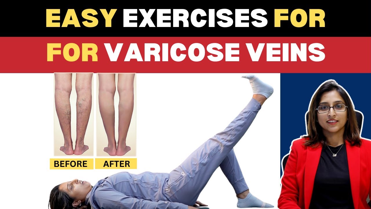 Easy Exercises for Varicose Veins on legs  Dr Kaurabhi Zade