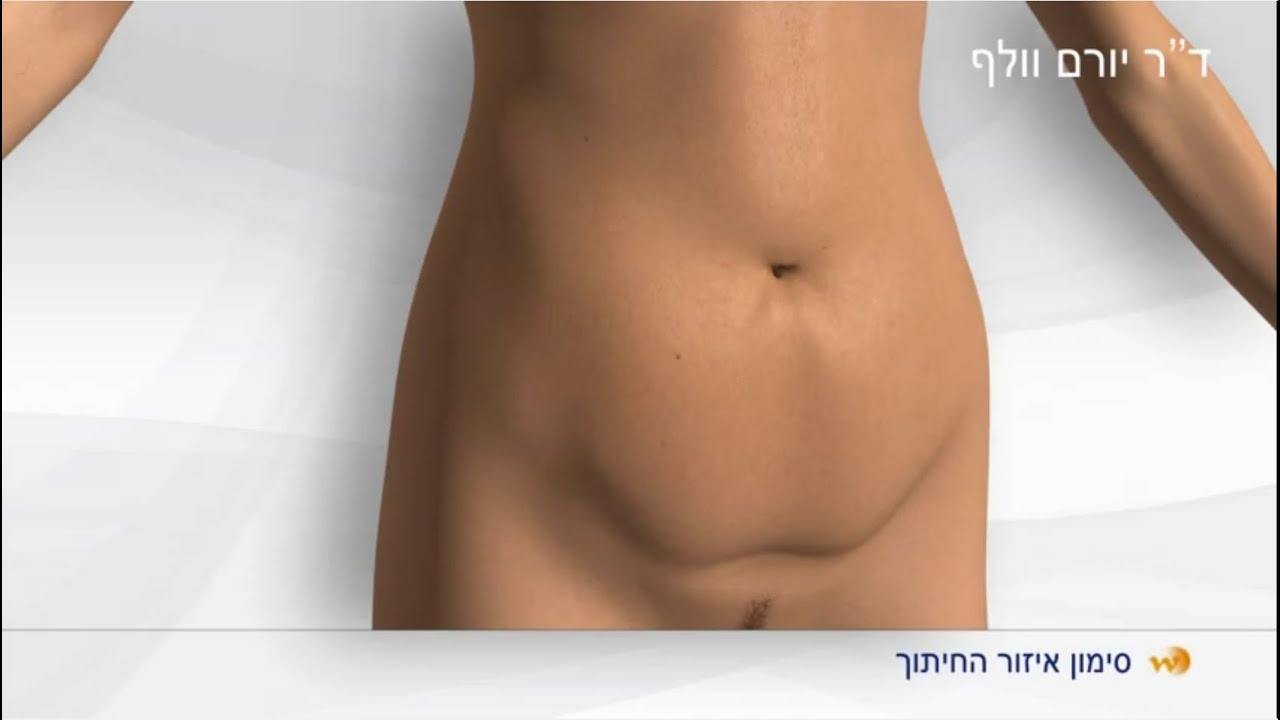 הדמיית מתיחת בטן  דר' יורם וולף - Tummy Tuck DR Yoram Wolf