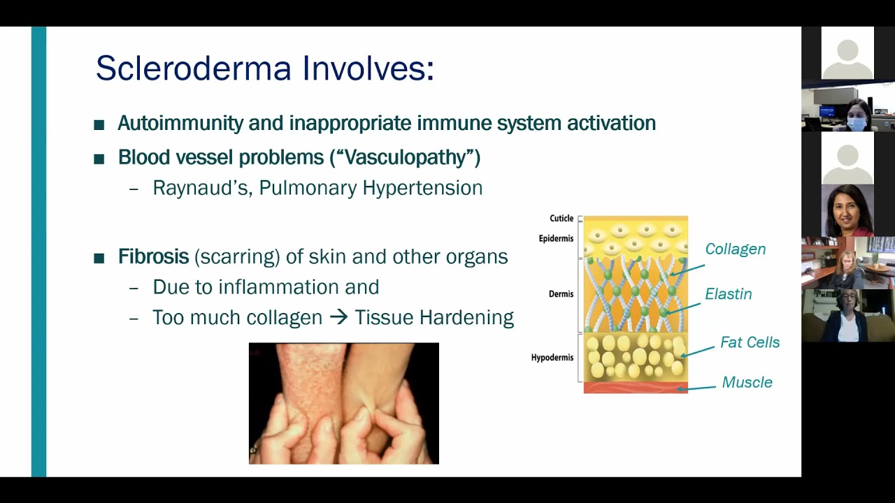 Overview of Juvenile Systemic Sclerosis