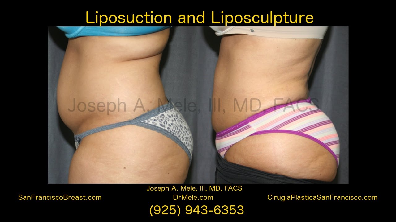 Tumescent Liposuction the Liposculpture of Fat in the SF Bay Area- 15